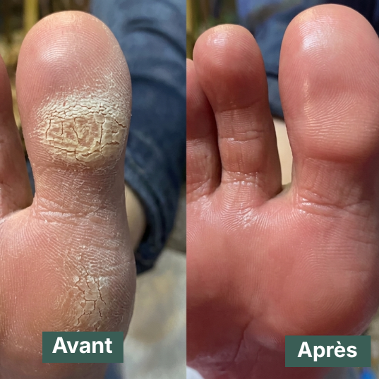 Sauvasine™ Le Savon Antifongique